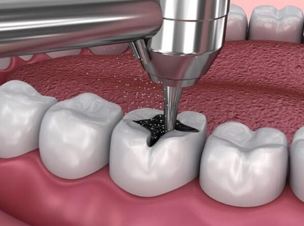 گلاس آینومر ترمیمی لایت کیور هیوج HUGE