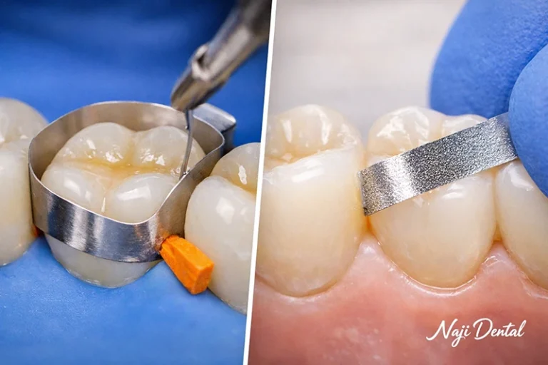 تفاوت های نوار پرداخت و نوار ماتریکس دندانپزشکی